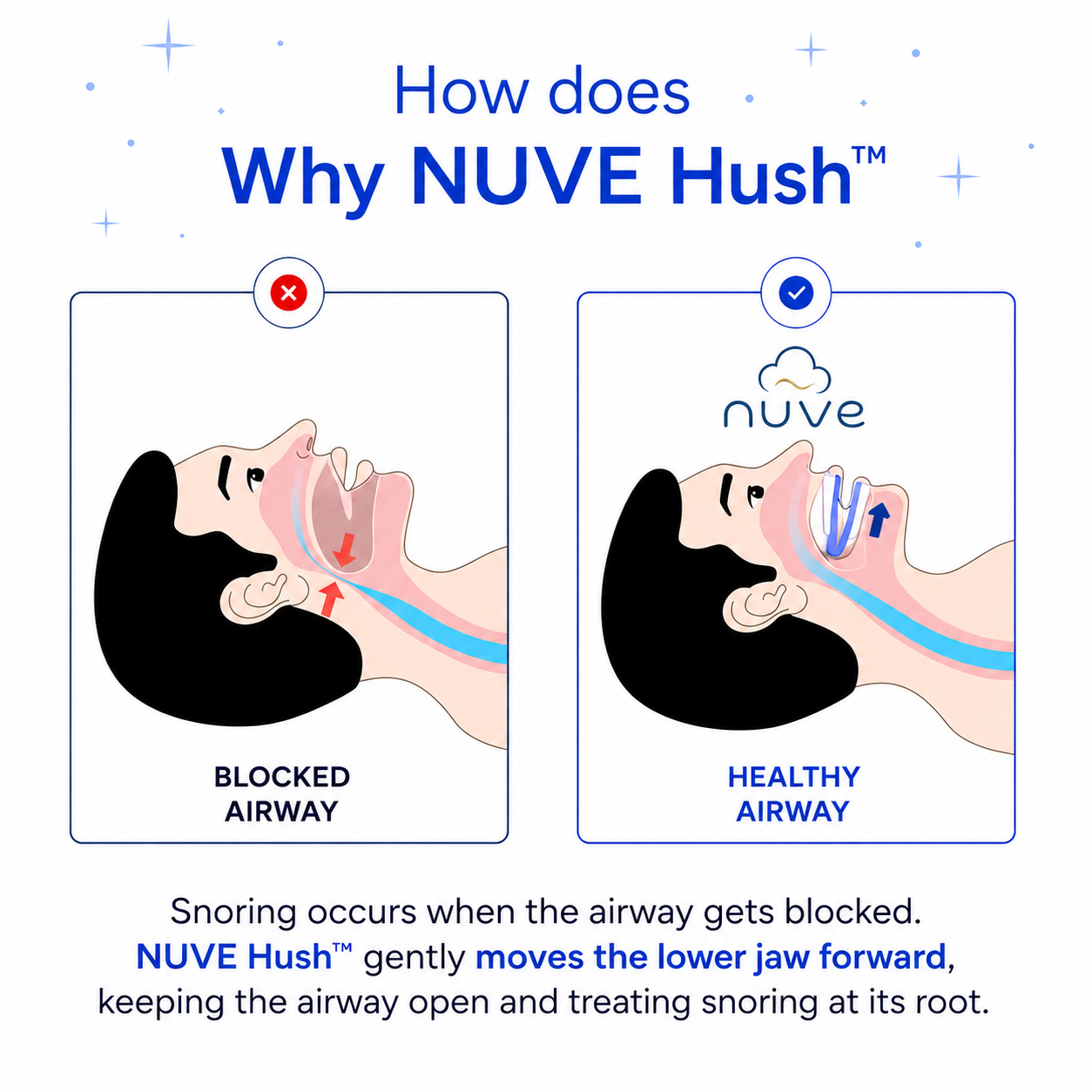 NUVE Hush™ — Anti-Snoring Mouthpiece